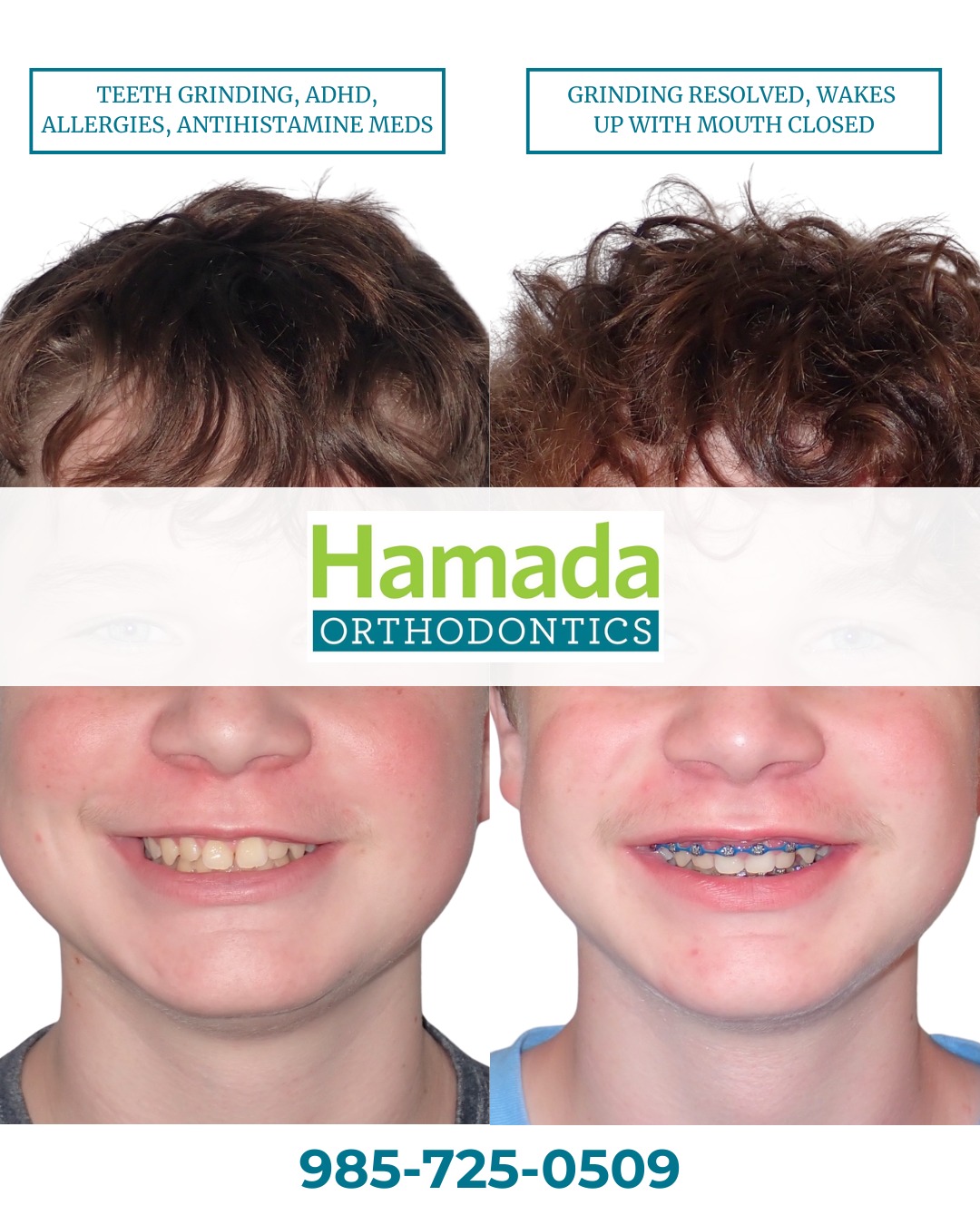 Before and after photos of a child patient showing teeth grinding, ADHD, and allergies resolved after airway-focused orthodontic treatment at Hamada Orthodontics