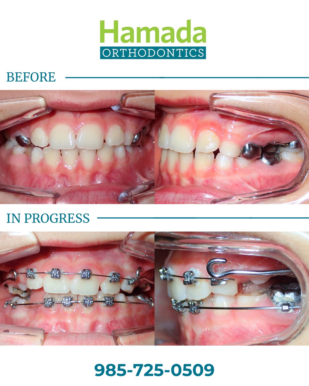 Before and in-progress photos of a child's orthodontic treatment at Hamada Orthodontics showing metal braces and jaw expansion to address teeth grinding and mouth breathing