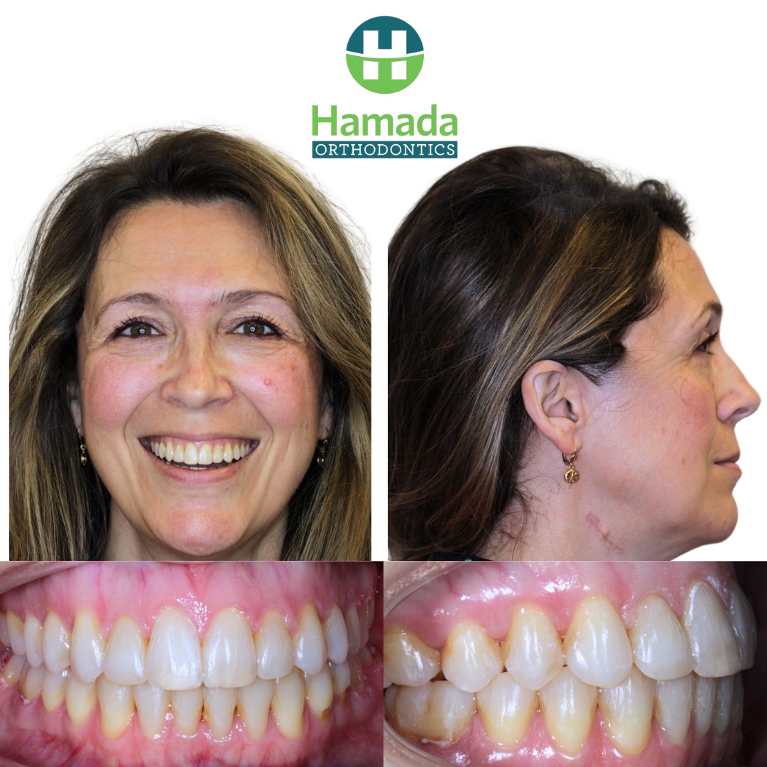TMJ Disorder Treatment in Metairie - Patient showing smile and jaw transformation after treatment at Hamada Orthodontics