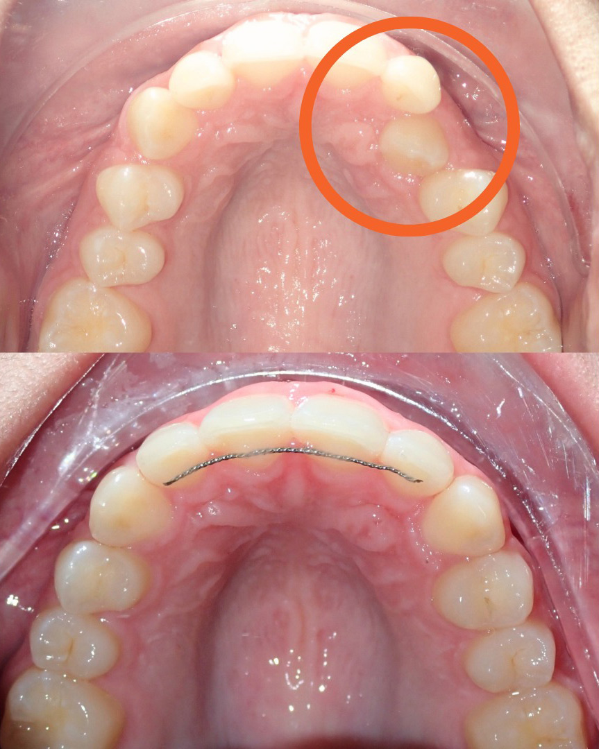 Anterior Crossbite Before and After Hamada Orthodontics - Hamada Orthodontics Before and after photos of anterior crossbite treatment at Hamada Orthodontics in Metairie showing a misaligned upper tooth corrected into proper alignment