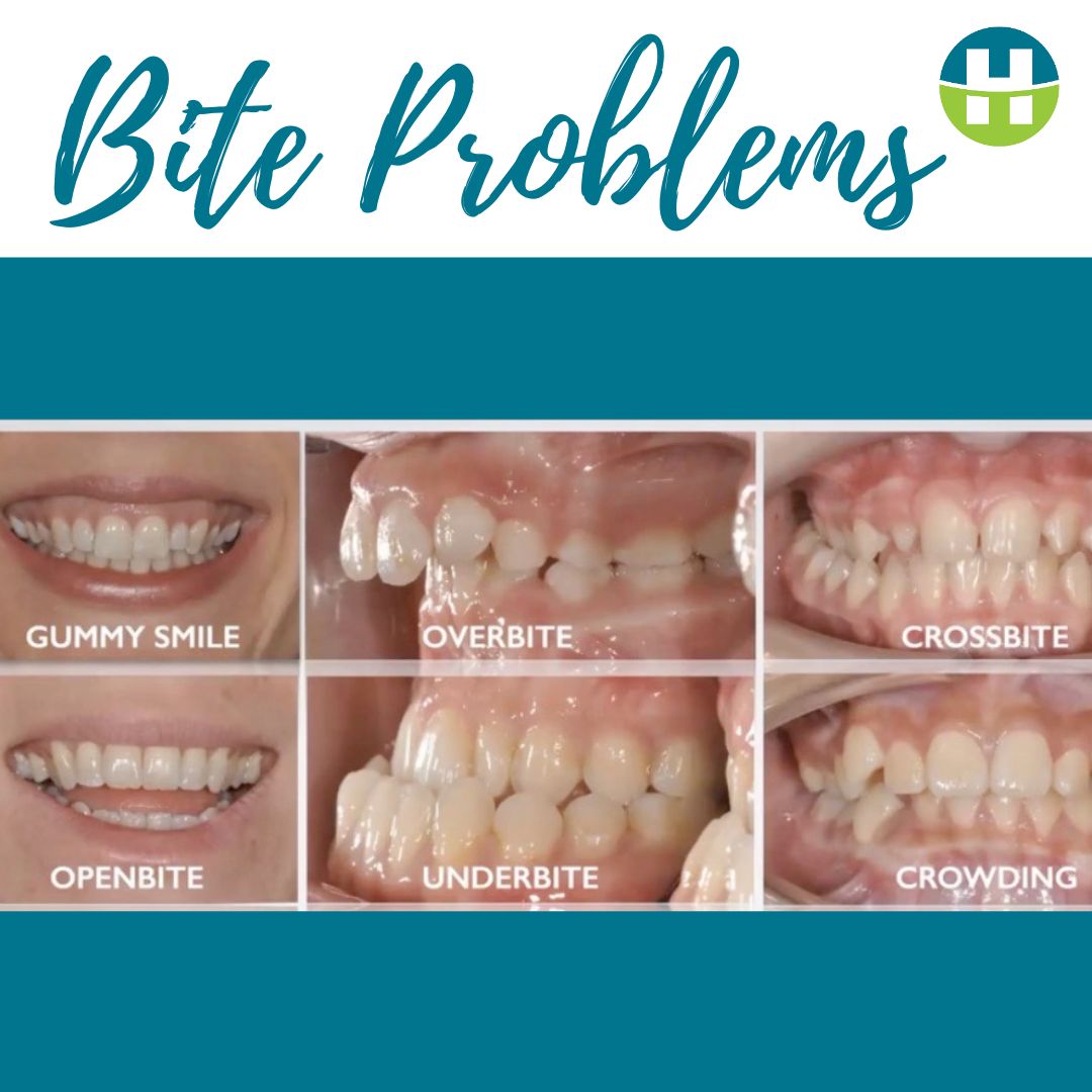 Bite Problems and Airway Orthodontics in New Orleans Hamada Orthodontics - Hamada Orthodontics Six common bite problems treated with airway orthodontics in New Orleans at Hamada Orthodontics, including gummy smile, overbite, crossbite, open bite, underbite, and crowding. Many of these conditions are linked to underlying tongue and airway dysfunction.