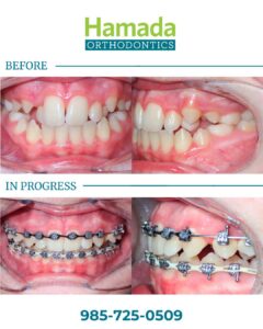 Before and in-progress photos of metal braces in Metairie showing severe teeth crowding being corrected at Hamada Orthodontics
