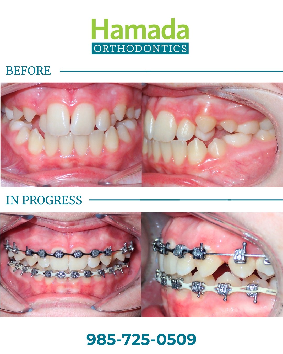 Before and in-progress photos of metal braces in Metairie showing severe teeth crowding being corrected at Hamada Orthodontics