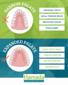 Infographic comparing narrow palate vs expanded palate. Narrow palate causes crowded teeth, small tongue space, breathing issues, and poor sleep. Expanded palate provides more teeth space, proper tongue posture, better airflow, and deeper sleep. Hamada Orthodontics Metairie LA.