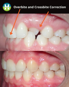 Before and after overbite and crossbite treatment in New Orleans at Hamada Orthodontics showing corrected bite alignment
