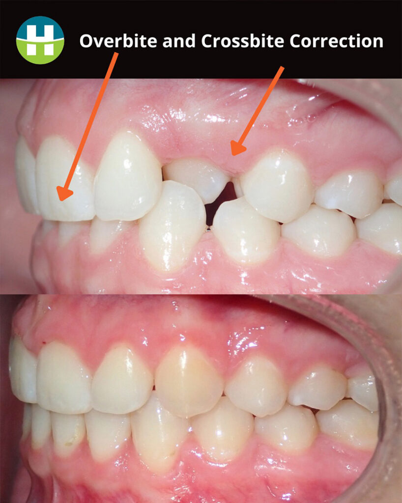 Overbite and Crossbite Treatment in New Orleans Hamada Orthodontics - Hamada Orthodontics Before and after overbite and crossbite treatment in New Orleans at Hamada Orthodontics showing corrected bite alignment