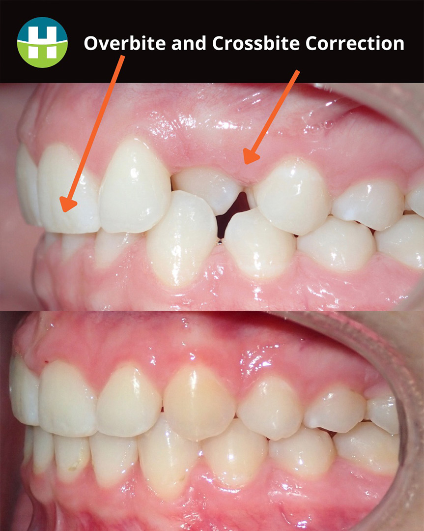 Overbite and crossbite before and after at Hamada Orthodontics