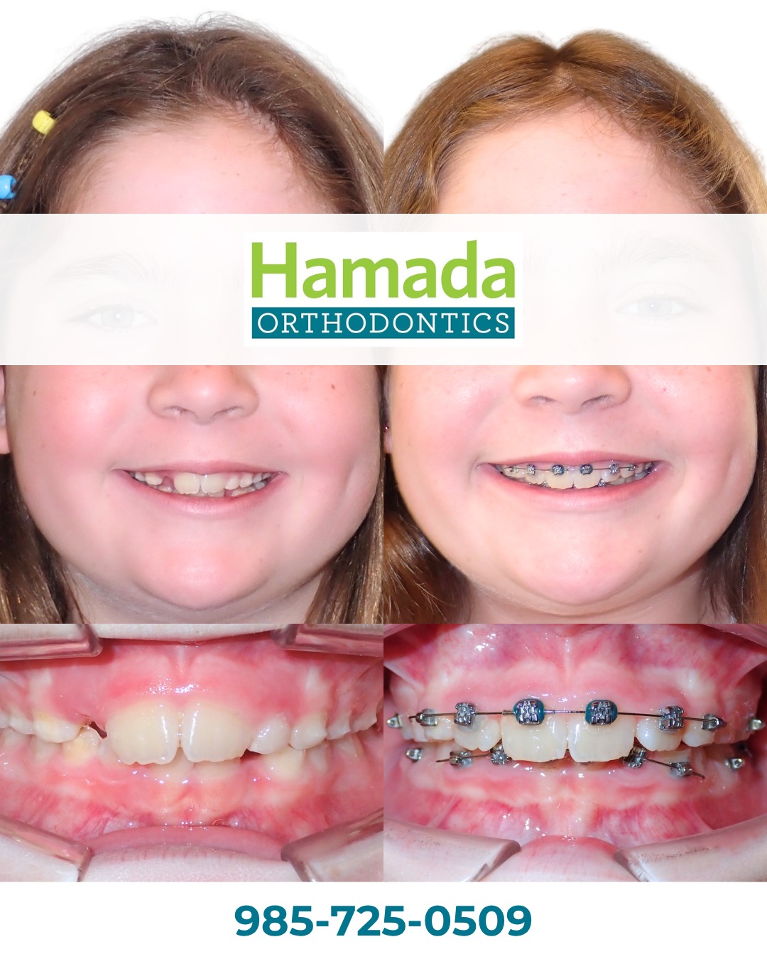 Before and after photos showing crossbite correction with braces at Hamada Orthodontics - child's smile transformation with palatal expansion treatment in Metairie, LA