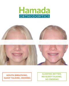 Young patient before airway-focused orthodontic treatment showing mouth breathing and narrow jaw development at Hamada Orthodontics
