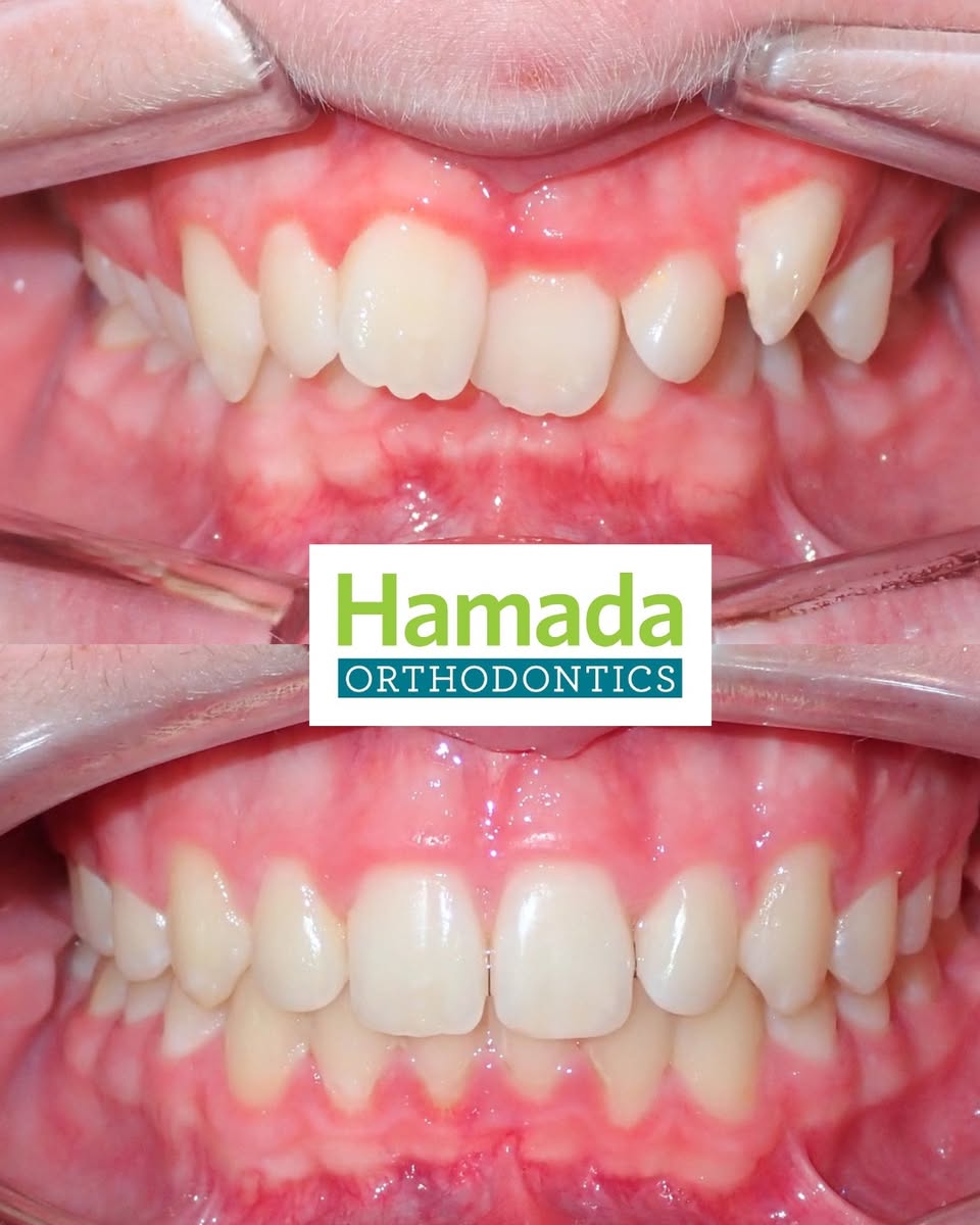 Before and after orthodontic results at Hamada Orthodontics showing a crowded smile corrected through arch development and alignment without extractions.