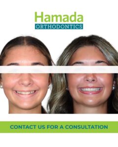 Before and after smile of a Hamada Orthodontics patient in the New Orleans area, crowded front teeth straightened into an even smile