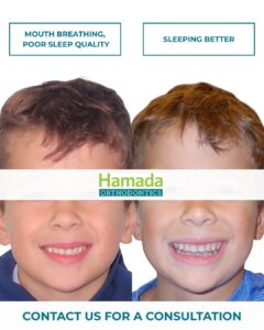 Two side-by-side photos of a young boy: left shows crowded teeth before braces, right shows a straighter smile after orthodontic treatment, for Hamada Orthodontics.