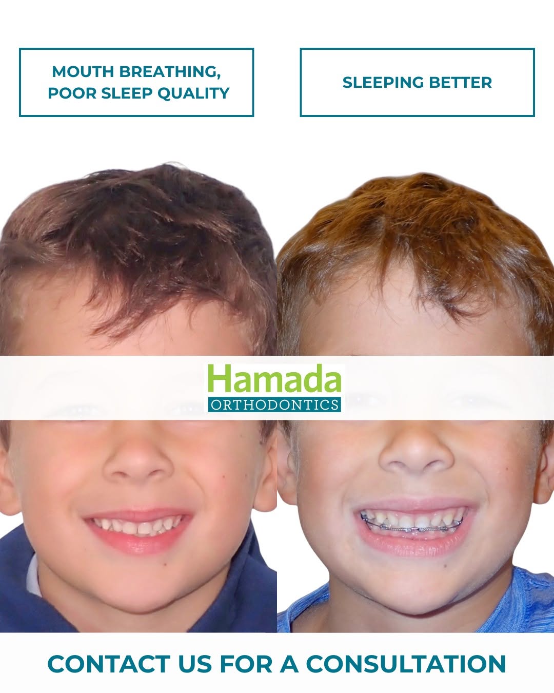 Before and after of a young Hamada Orthodontics patient who went from mouth breathing and poor sleep to sleeping better after early airway-focused orthodontic treatment in the New Orleans area