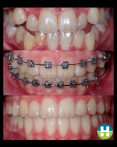 Before, during, and after views of a Hamada Orthodontics patient treated with metal braces in the New Orleans area